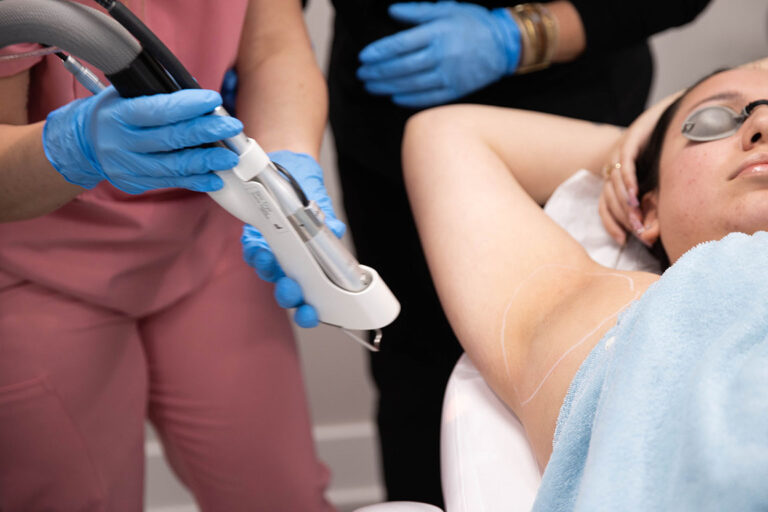 armpit laser hair removal